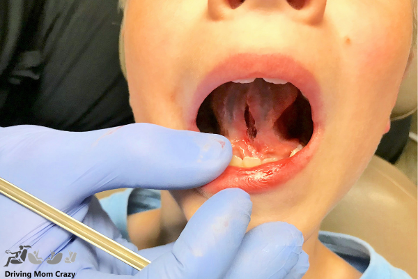 Tongue tie procedure with laser at pediatric dentist